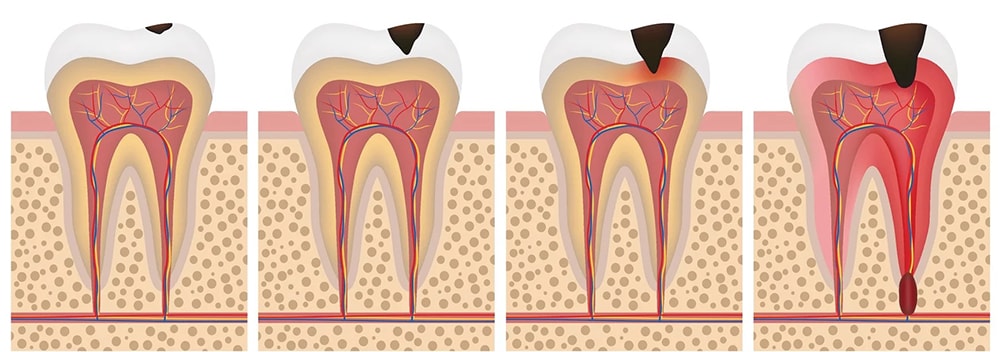fasi carie denti dentista lecce