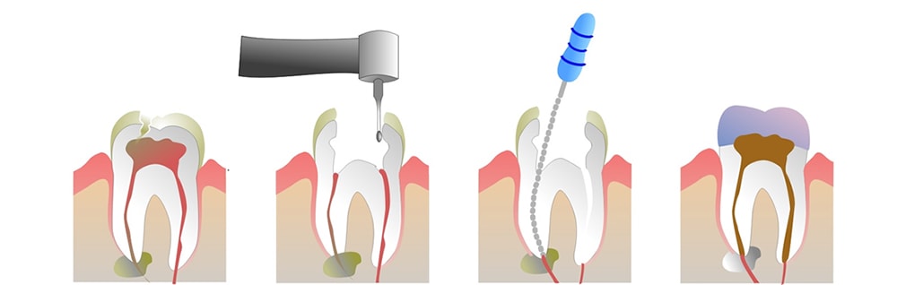 Endodonzia lecce devitalizzazione dente