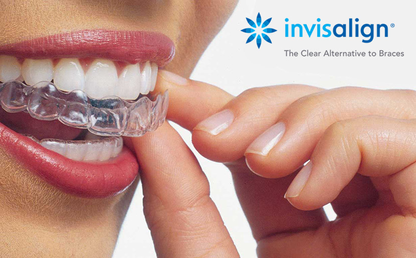 apparecchio invisibile Invisalign Lecce