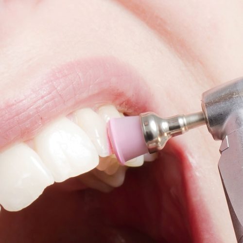 Pulizia dei denti professionale: cos’è e ogni quanto andrebbe svolta