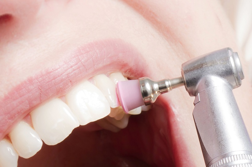 Pulizia dei denti professionale: cos’è e ogni quanto andrebbe svolta