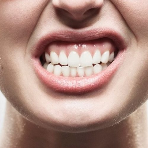 Malocclusione dentale: sintomi e pericoli di un disturbo trattabile