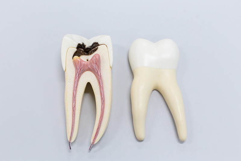 Devitalizzazione del dente: quando serve e come viene effettuata