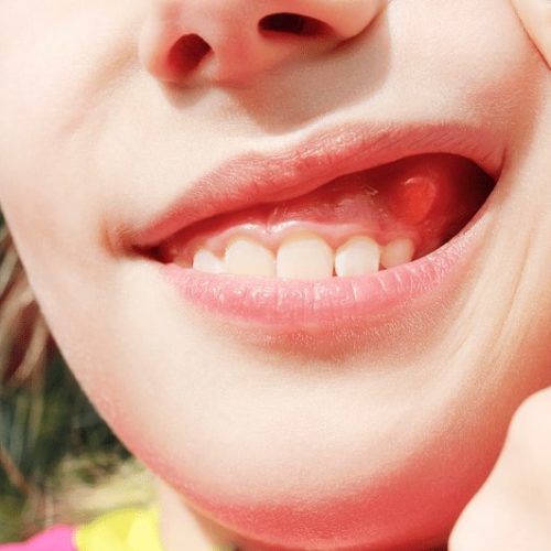 Come si riconosce e si cura l’ascesso dentale?