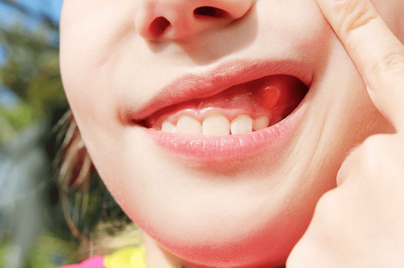 Come si riconosce e si cura l’ascesso dentale?