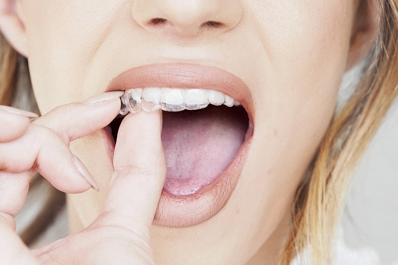 INVISALIGN dentista Lecce