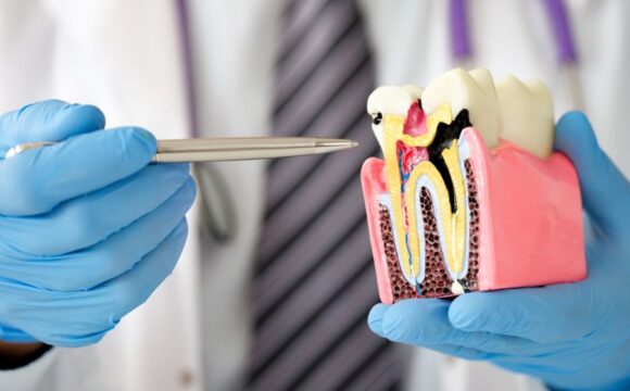 Carie dentali: come prevenirle con i consigli giusti